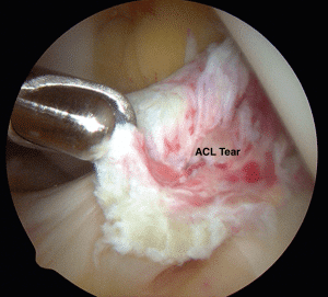 ACL Tear Surgical Treatment Harrison NY