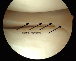 Normal Torn Meniscus Doctor Westchester County NY 
