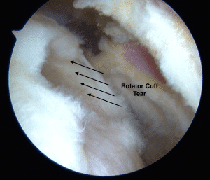 Rotator Cuff Tear Treatment Harrison NY