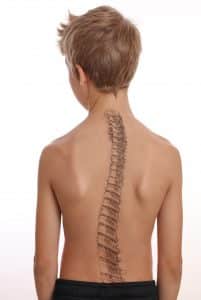 Scoliosis Treatment Harrison NY