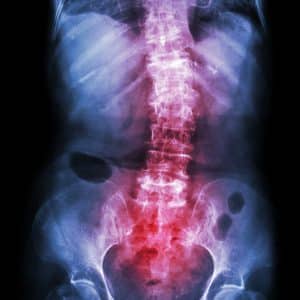 film x-ray of a patients spine showing how crooked it is. The person has Spondylosis and Scoliosis and is a prime candidate for cervical fusion surgery