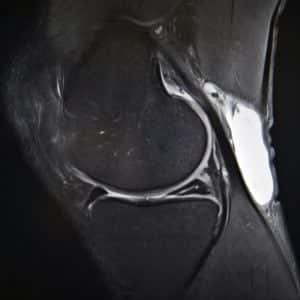 Torn Meniscus Treatment Westchester County NY