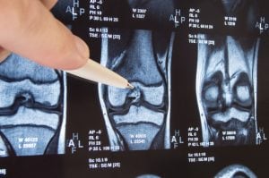 ACL Tear Treatment Harrison NY