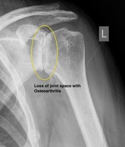 Shoulder Arthritis Diagnosis Harrison NY