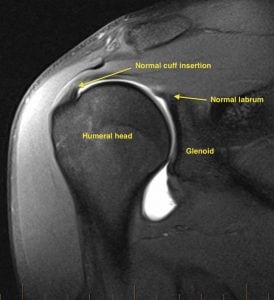 Rotator Cuff Tear Diagnosis Westchester County NY
