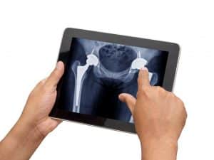 Knee Arthroplasty Harrison NY