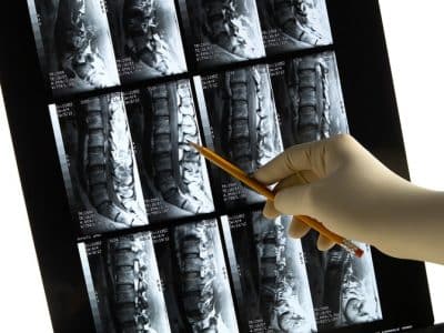 Lower back MRI scan with gloved physician's hand & pencil