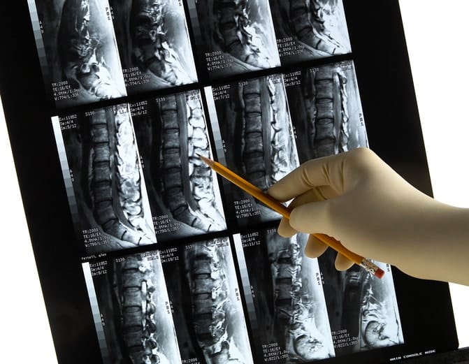 Lower back MRI scan with gloved physician's hand & pencil