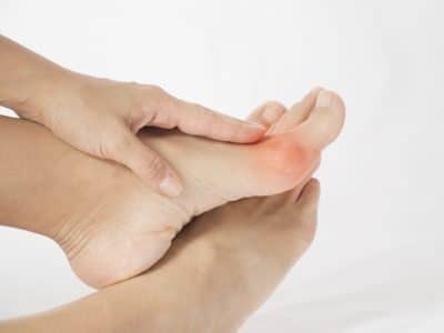 bunion in foot problem
